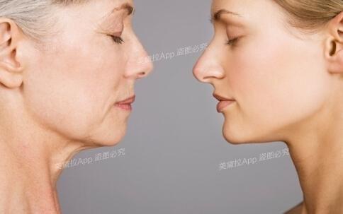 日本名医:对付初老做埋线提升更持久