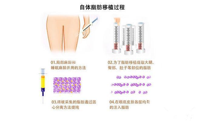 脂肪移植那些事儿:自己的脂肪也有风险