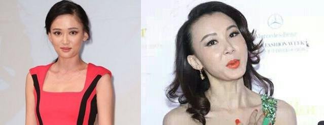 颧骨高也能打瘦脸针,打点玻尿酸就行